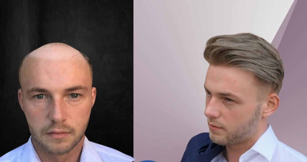 Non-surgical hair replacement option with men’s hair systems